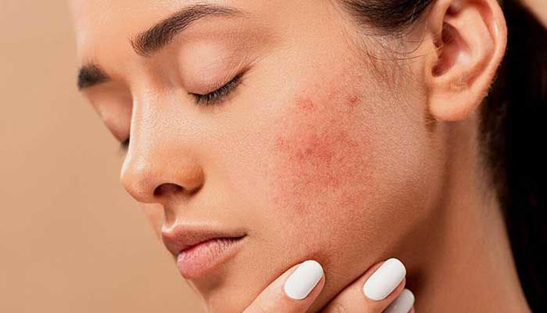 Picture of Rosacea in rdečica kože!