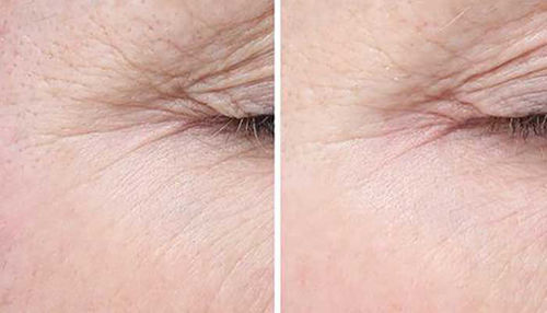 Staranja kože ne moremo preprečiti, lahko pa ga upočasnimo!