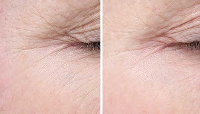 Picture of Staranja kože ne moremo preprečiti, lahko pa ga upočasnimo!