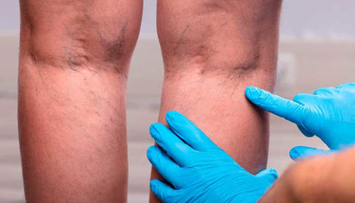 Vodnik za zdrave vene s pomočjo A.Vogla