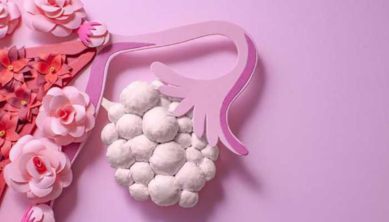 Picture of Sindrom policističnih jajčnikov in mio-inositol!