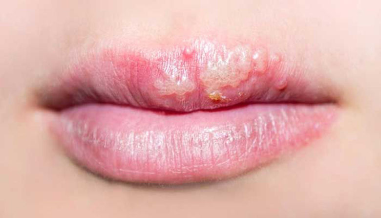 Picture of HERPES pri otroku