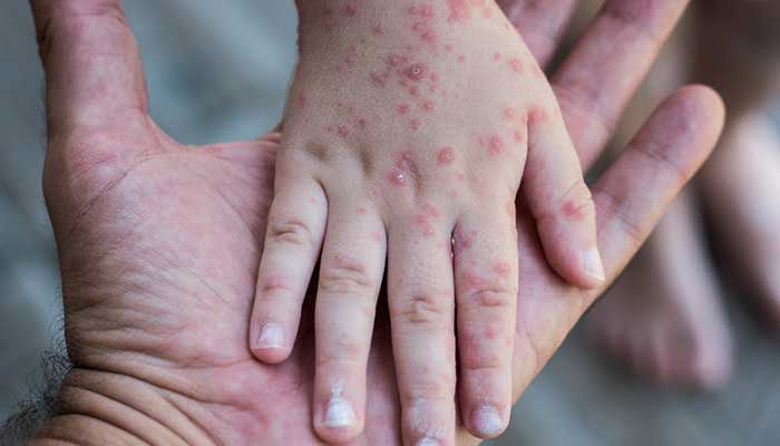 Picture of RDEČKE PRI OTROKU