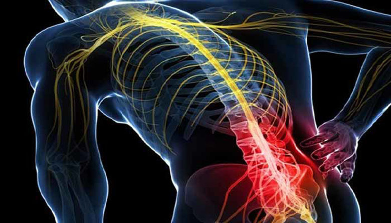 Picture of Išias, vkleščen živec - vzroki, simptomi in zdravljenje!