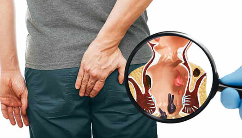 Picture of Hemoroidi ali hemeroidi? 10 nasvetov