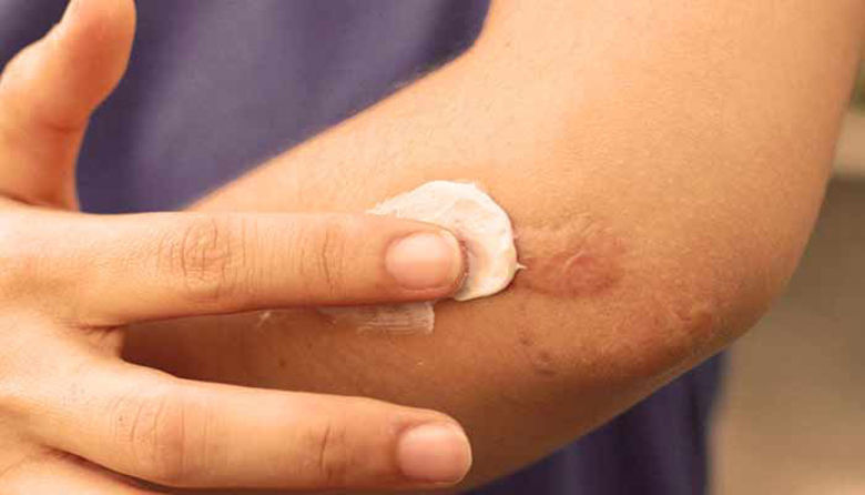 Picture of Krema za brazgotine - po operaciji!