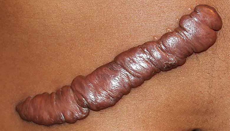 Picture of Keloidna brazgotina!