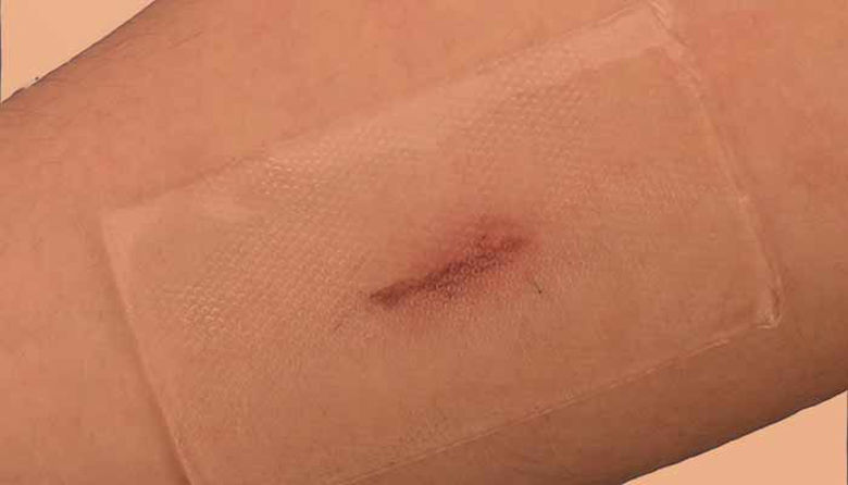 Picture of Silikonski gel za brazgotine