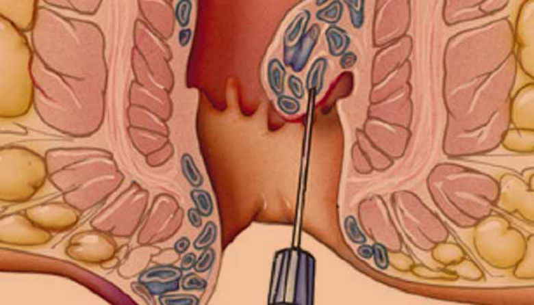 Picture of Detralex hemoroidi forum
