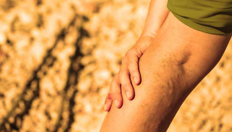 Picture of Žile na nogah