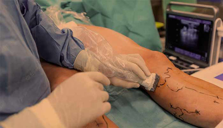 Picture of Operacija krčnih žil