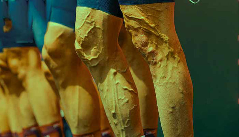 Picture of KRČNA ŽILA - varikozna vena