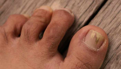 Kako odpraviti glivice na nohtih forum