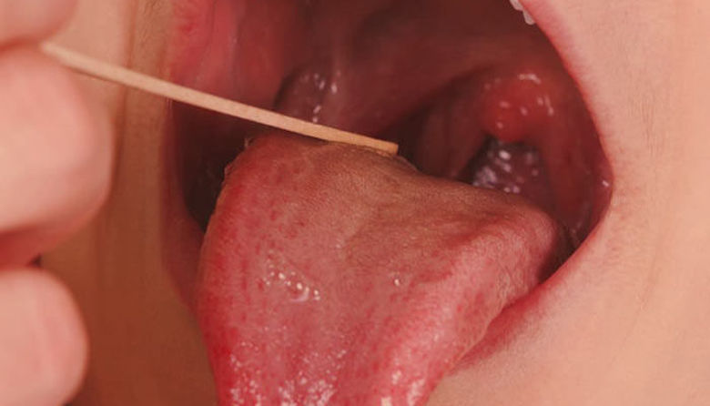 Picture of Naravni antibiotik za grlo