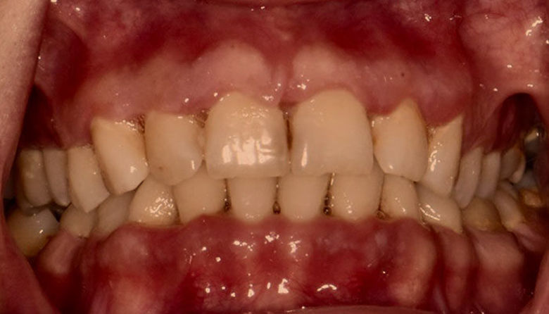 Picture of Vnetje dlesni Forum