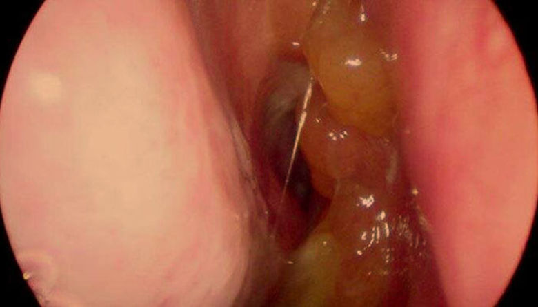 Picture of Vnetje nosne sluznice