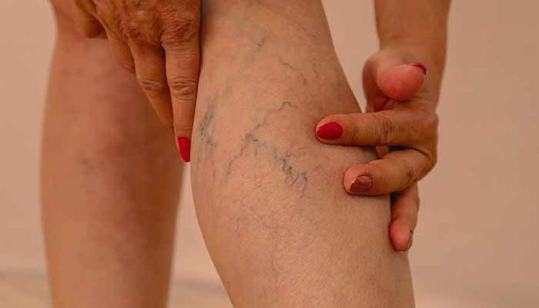 Picture of Jabolčni kis za krčne žile