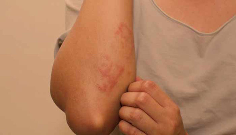 Picture of Srbeča koža forum