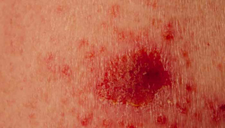 Picture of Srbenje kože rak