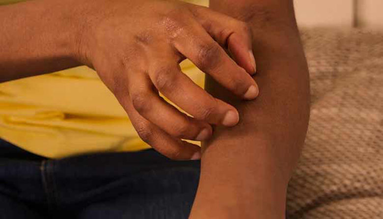 Picture of Srbeča koža po celem telesu