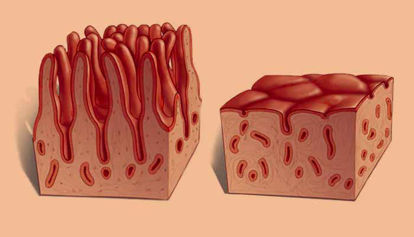 Vneto črevesje znaki