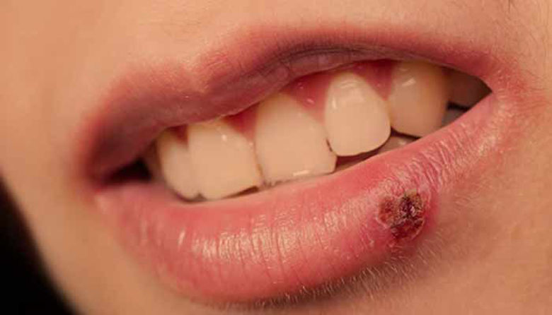 Picture of Herpes - vse o njem + 4 totalna ZAVAJANJA!