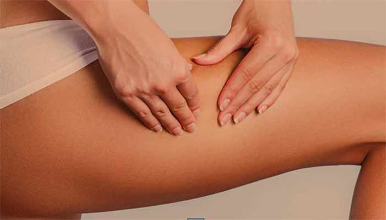 Picture of Celulit - kako se ga uspešno znebiti?