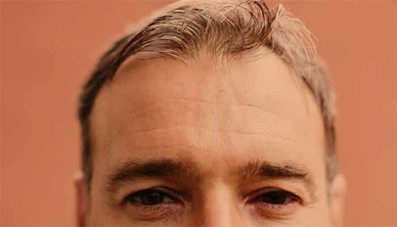 Picture of Prekomerno izpadanje las forum