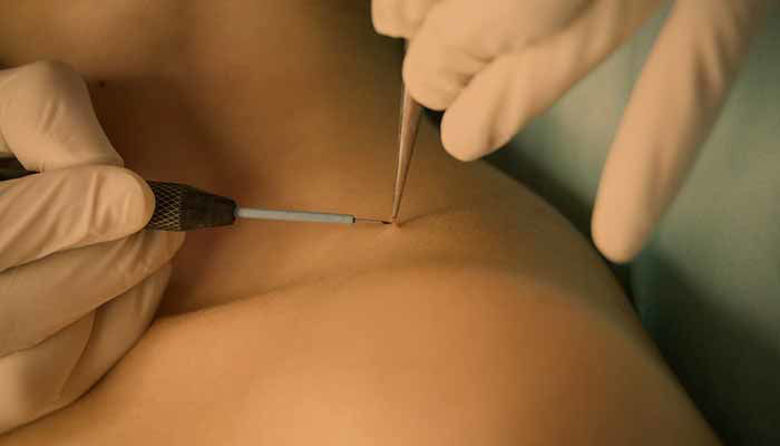 Picture of Kako odstraniti papilome