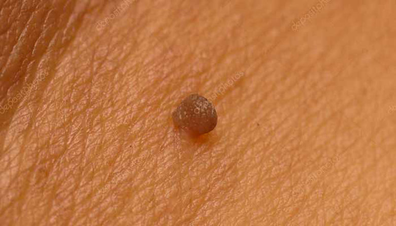 Picture of Kožni papilomi