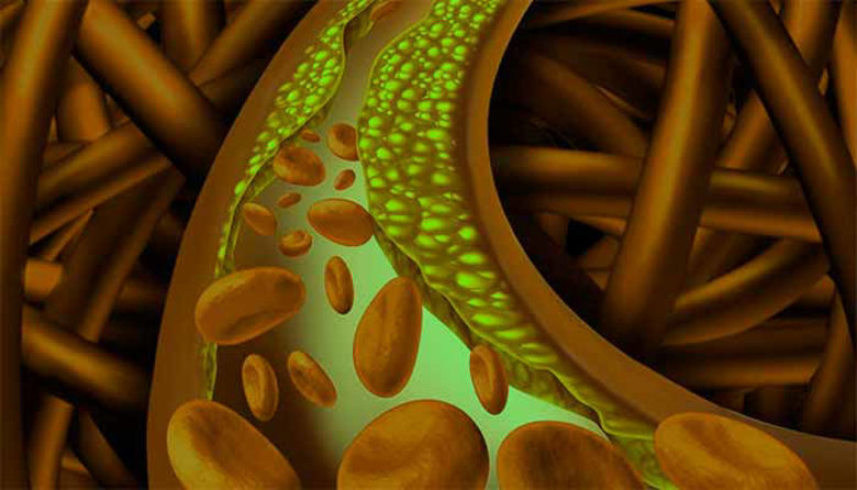 Picture of ATEROSKLEROZA: razkrit tihi morilec vaših arterij!