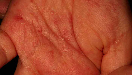 GARJE - ko napadejo, zakaj srbi? Kako si pomagati?