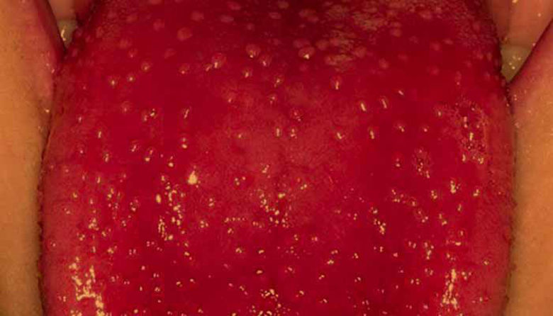 Picture of Škrlatinka: bakterijska okužba otrok - simptomi in zdravljenje