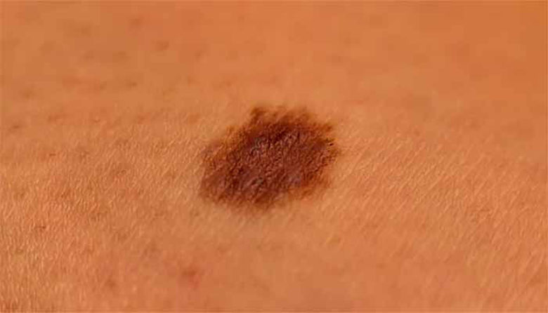 Picture of Kožni rak