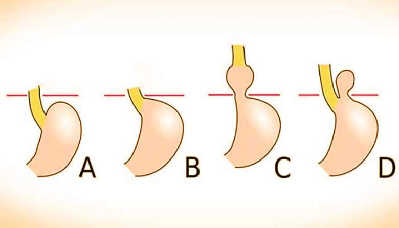 Picture of Kila (hiatusna) - tako jo prepoznate!