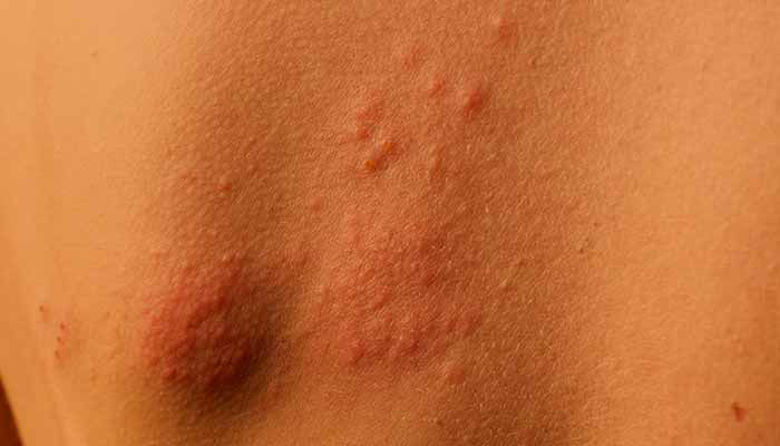 Picture of HERPES ZOSTER ali PASOVEC: Vzroki, Simptomi in Zdravljenje!