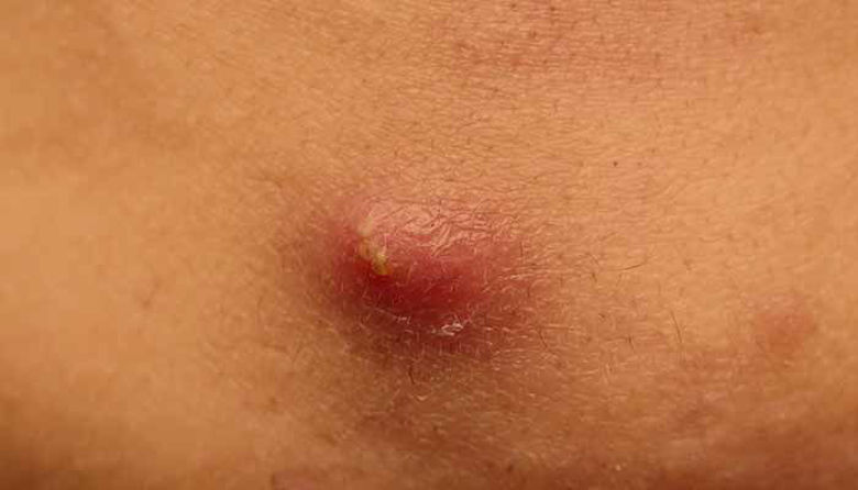 Picture of Tur ali furunkel