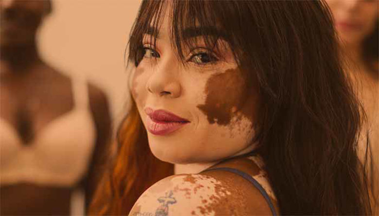 Picture of Vitiligo