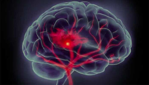 PARKINSONOVA BOLEZEN: Vzroki, Simptomi in možnosti Zdravljenja