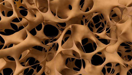 OSTEOPOROZA: vzroki, simptomi in strategije preprečevanja!