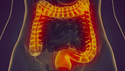 SINDROM RAZDRAŽENEGA ČREVESA: Vzroki, Simptomi in Zdravljenje