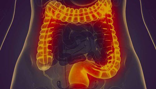 SINDROM RAZDRAŽENEGA ČREVESA: Vzroki, Simptomi in Zdravljenje