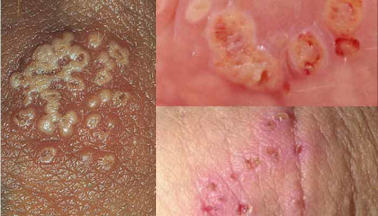 Picture of Vrste herpesa slike