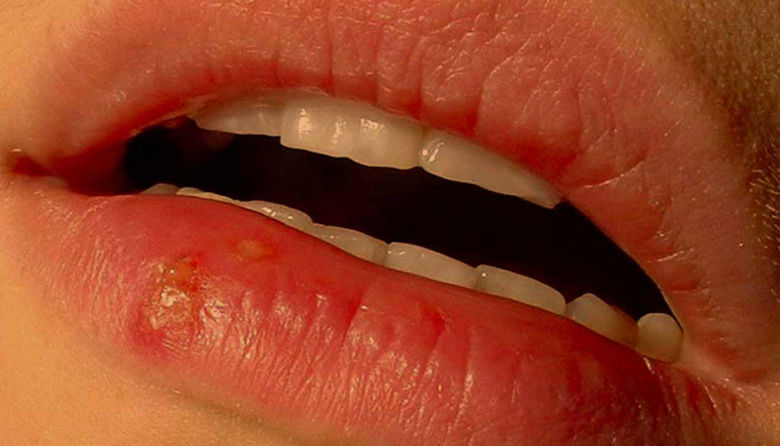 Picture of Herpes na ustnici