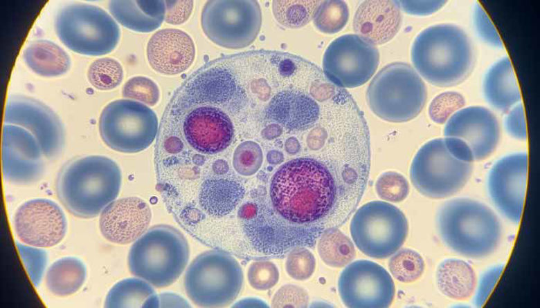 Picture of Povišani limfociti forum