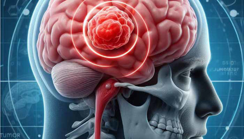 Picture of Tumor v Glavi: prepoznavanje znakov in iskanje rešitev