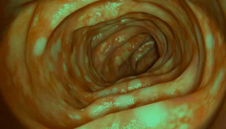 Picture of ULCEROZNI KOLITIS: premagajte Simptome in si povrnite Zdravje