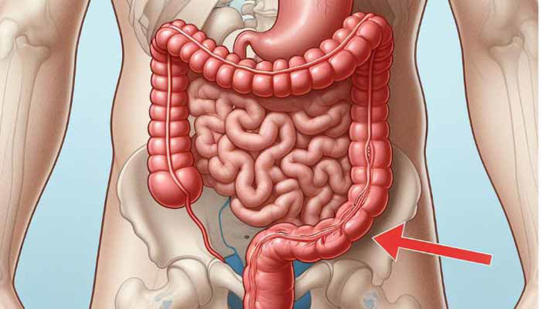 Picture of ILEUS in MEHANSKA ZAPORA ČREVESJA