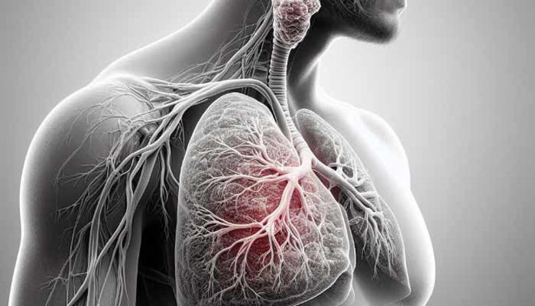 Picture of Adenokarcinom pljuč