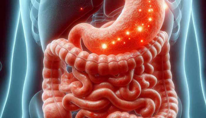 Picture of Biliarni Gastritis